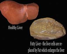 Fructose And Liver